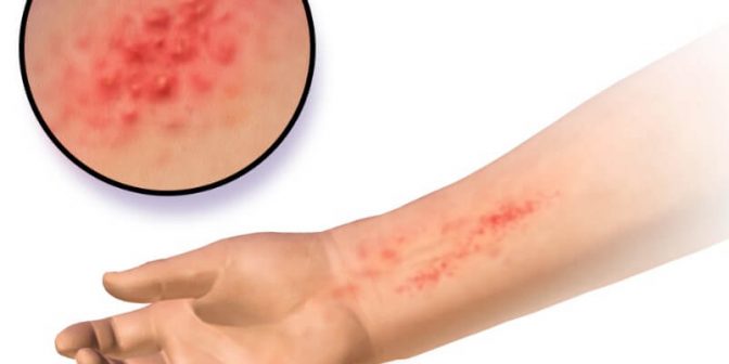 bahaya klorin bagi kesehatan