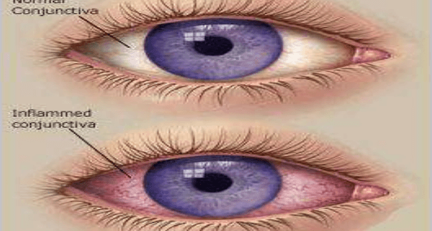 5 Penyebab Iritasi Mata Setelah Berenang & Cara Cegahnya