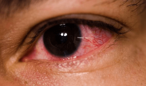 iritasi mata setelah berenang