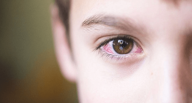 iritasi mata setelah berenang