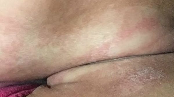 ruam leher bayi