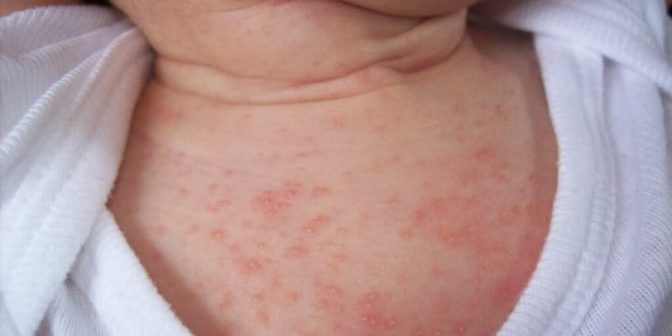 bentol-bentol pada bayi