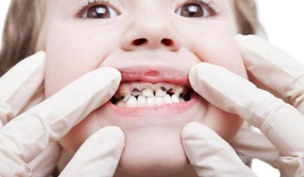 karies pada gigi anak