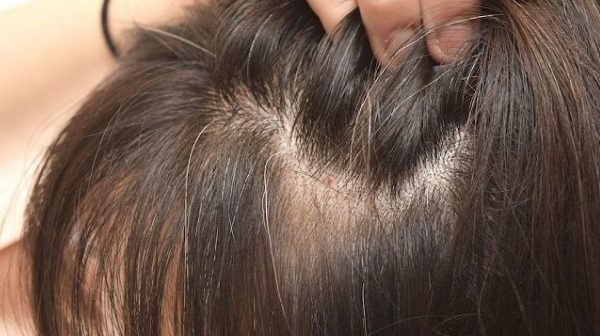 kutu rambut dan ketombe