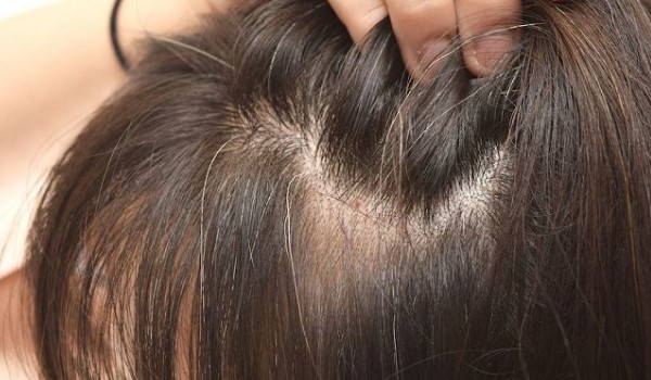 kutu rambut dan ketombe