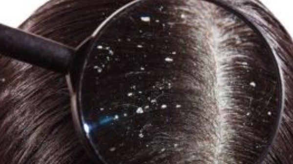 kutu rambut dan ketombe