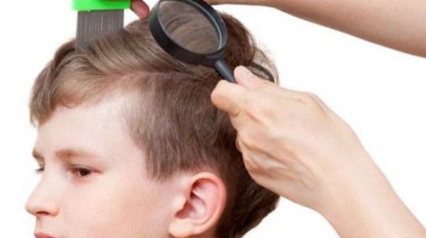 kutu rambut pada anak