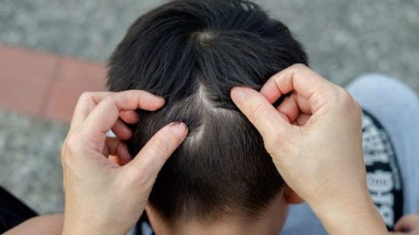 kutu rambut pada anak