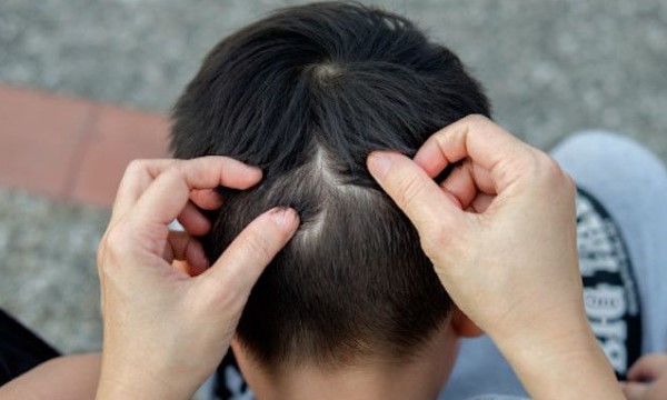 kutu rambut pada anak