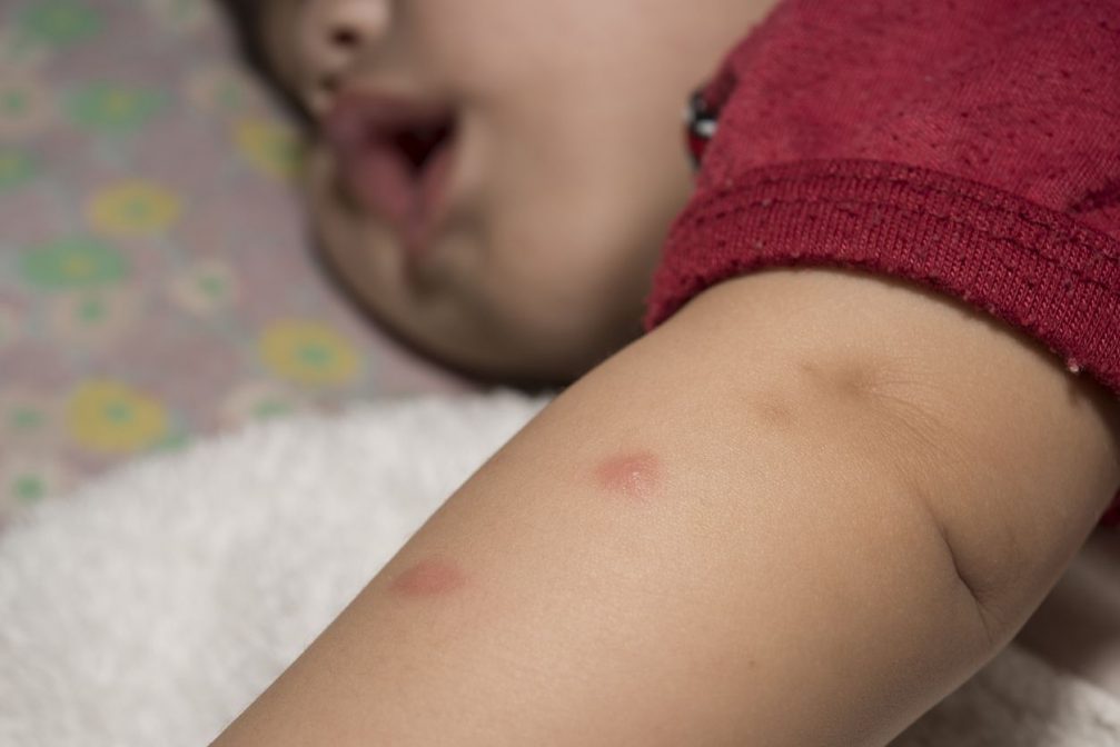 Gigitan nyamuk pada bayi