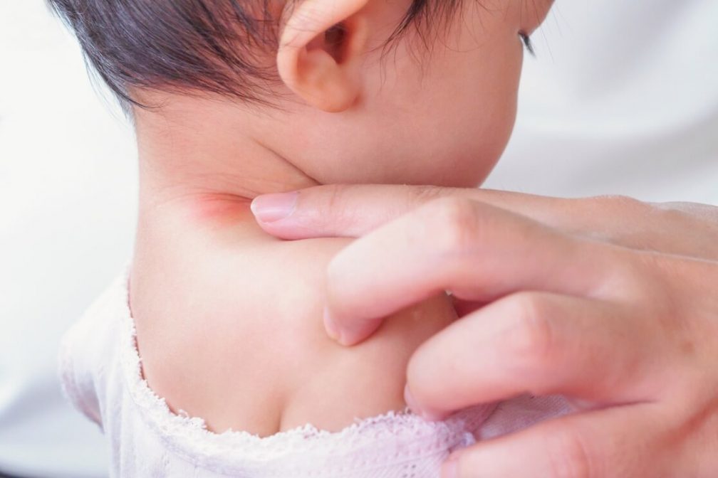 Gigitan Nyamuk Pada Bayi
