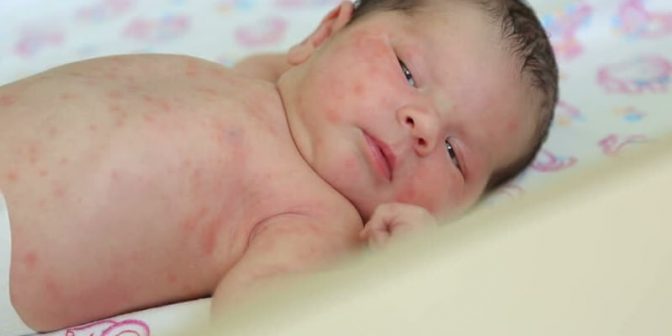 alergi kulit pada bayi
