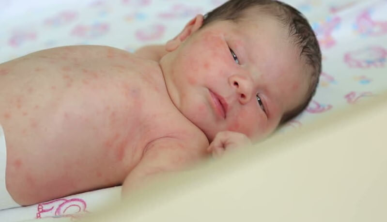 alergi kulit pada bayi