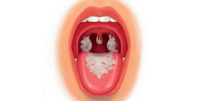 penyakit difteri pada anak