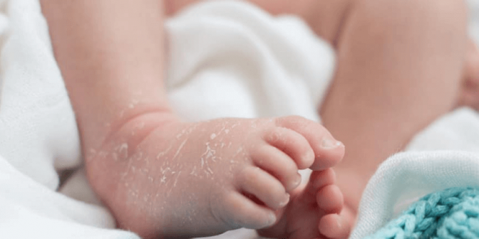 Masalah Kulit pada Bayi