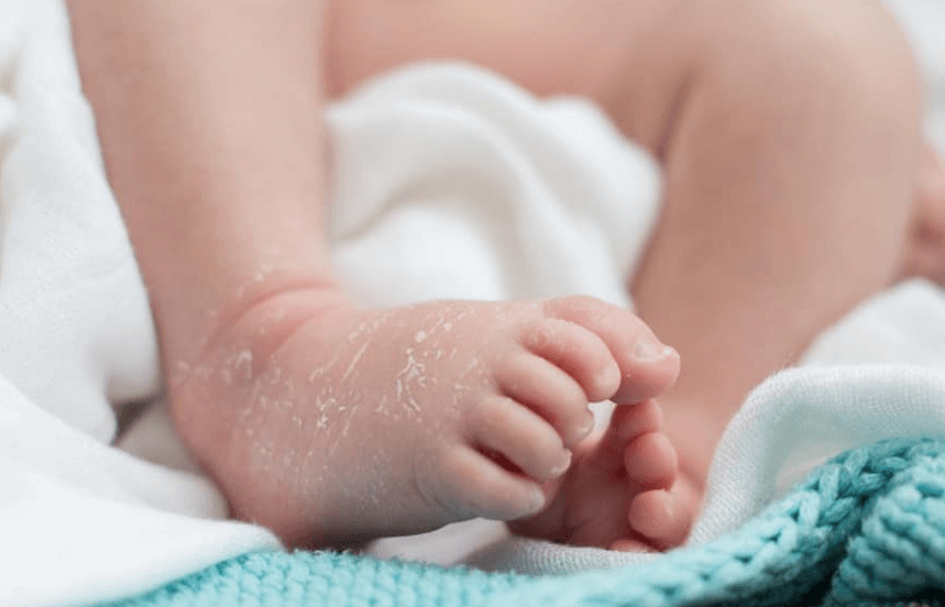 Masalah Kulit pada Bayi