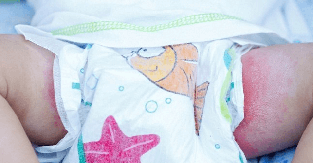 Masalah Kulit pada Bayi