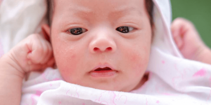 Masalah Kulit pada Bayi