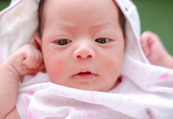 Masalah Kulit pada Bayi