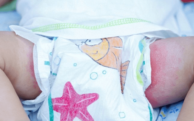 Masalah Kulit pada Bayi