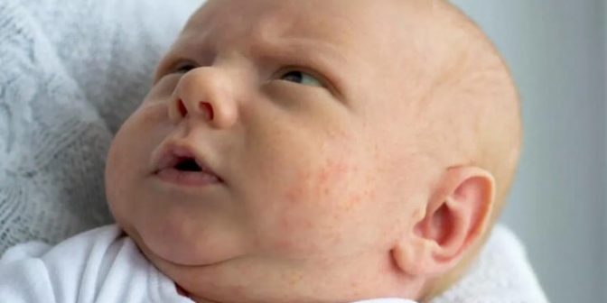 penyakit kulit pada bayi.jpg3.jpg