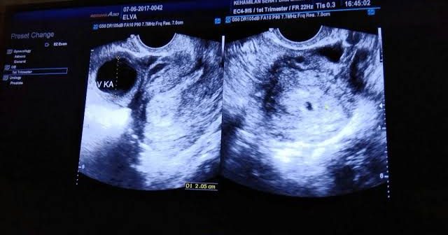 Syarat Melahirkan dengan BPJS & Biaya yang Ditanggung