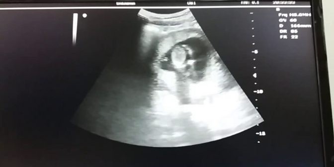 Ciri Hamil 3 Bulan: Masalah, Tips Bumil Harus Tahu