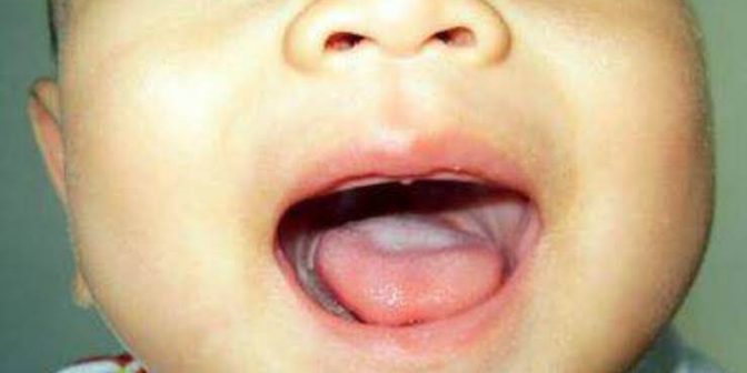 Lidah Bayi Puith via bidanku.com