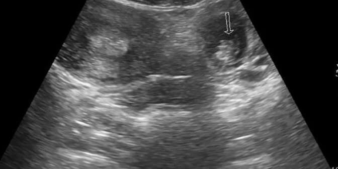 kehamilan ektopik via coreem.net