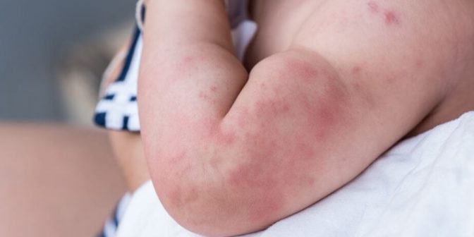 bintik merah pada bayi Sumber Momlovesbest.com