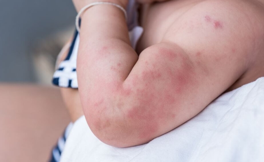 bintik merah pada bayi Sumber Momlovesbest.com
