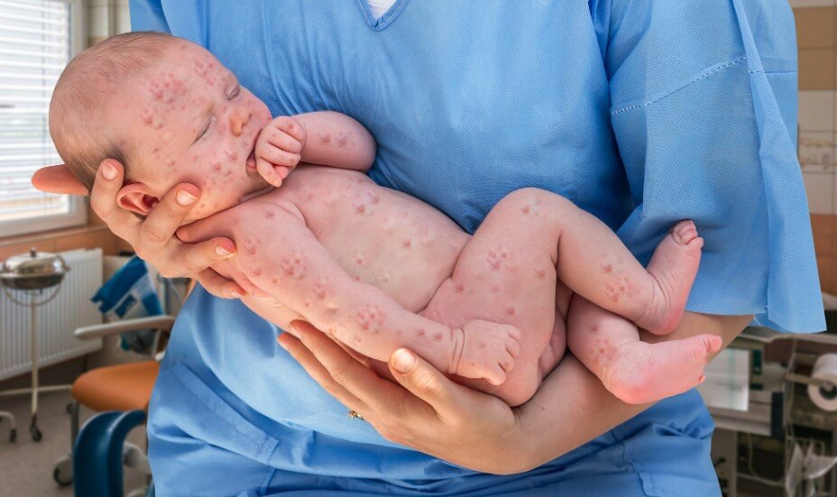 campak pada bayi Sumber timesofisrael.com