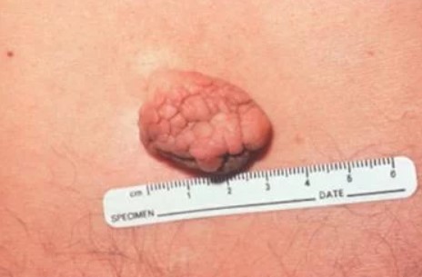 flek di awal kehamilan