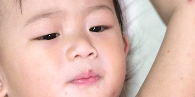 Herpes pada Bayi