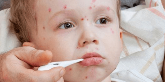 Cacar pada Bayi