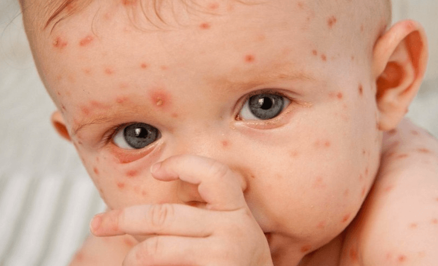 Cacar pada Bayi