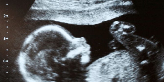 Polihidramnion pada Janin