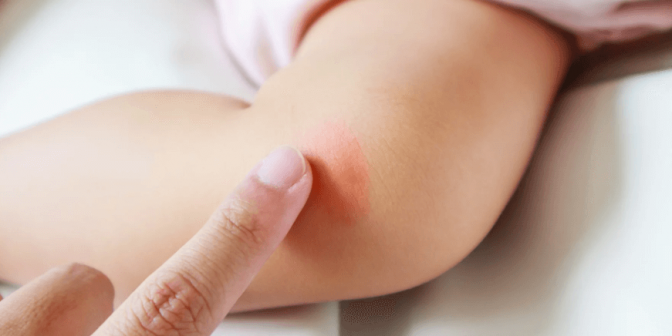 Jenis Penyakit Kulit pada Anak