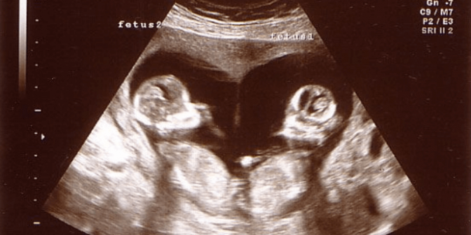 Ciri-Ciri Hamil Bayi Kembar