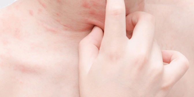 Jenis Penyakit Kulit pada Anak