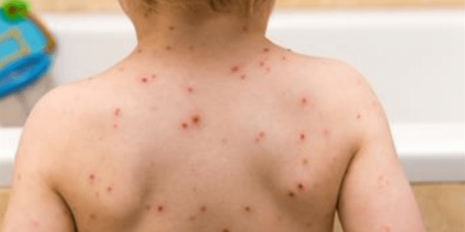 Jenis Penyakit Kulit pada Anak