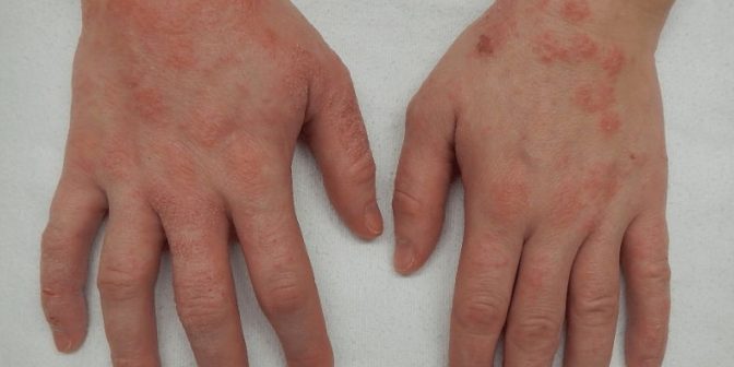 Jenis Penyakit Kulit pada Anak