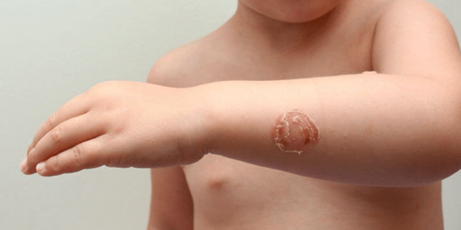 Jenis Penyakit Kulit pada Anak