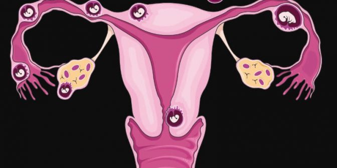 hamil di luar kandungan