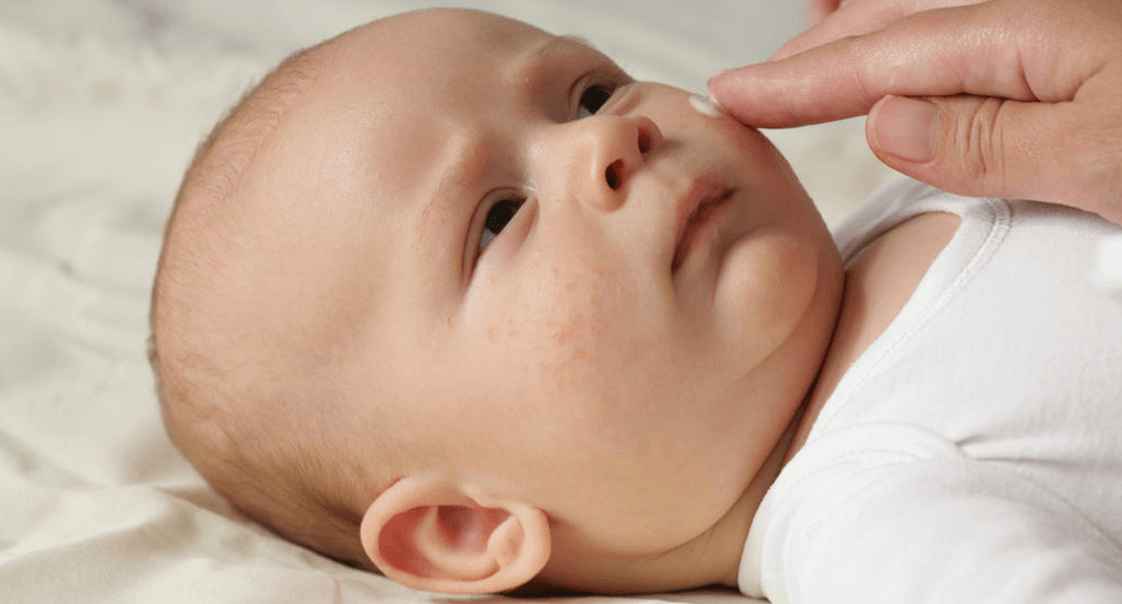 Kulit Kering pada Bayi