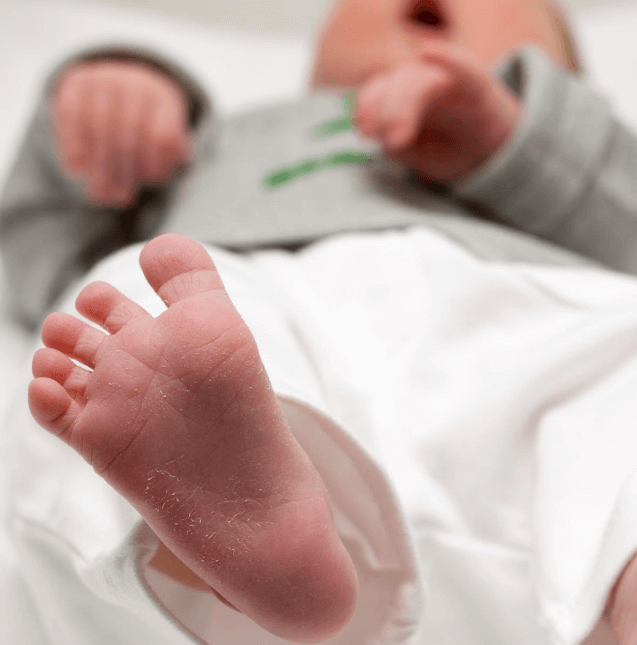 Kulit Kering pada Bayi