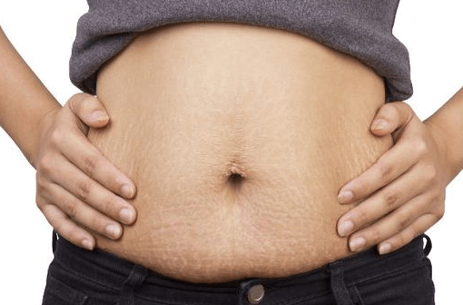 cegah stretch mark saat hamil