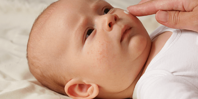 Eksim pada Bayi