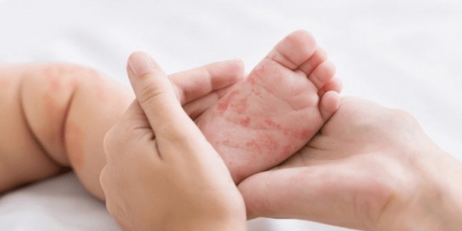 Obat Campak pada Bayi