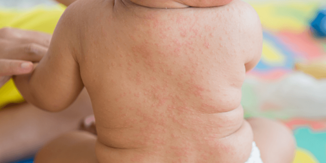 Obat Campak pada Bayi